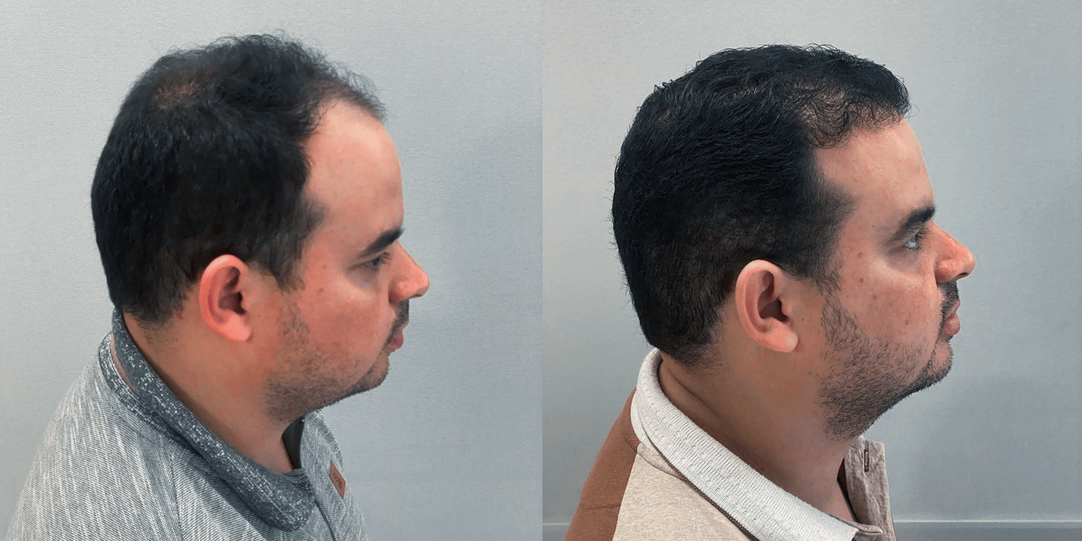 Terceira imagem de Antes e depois de um homem que fez um implante capilar com a Clinica Robotica Capilar
