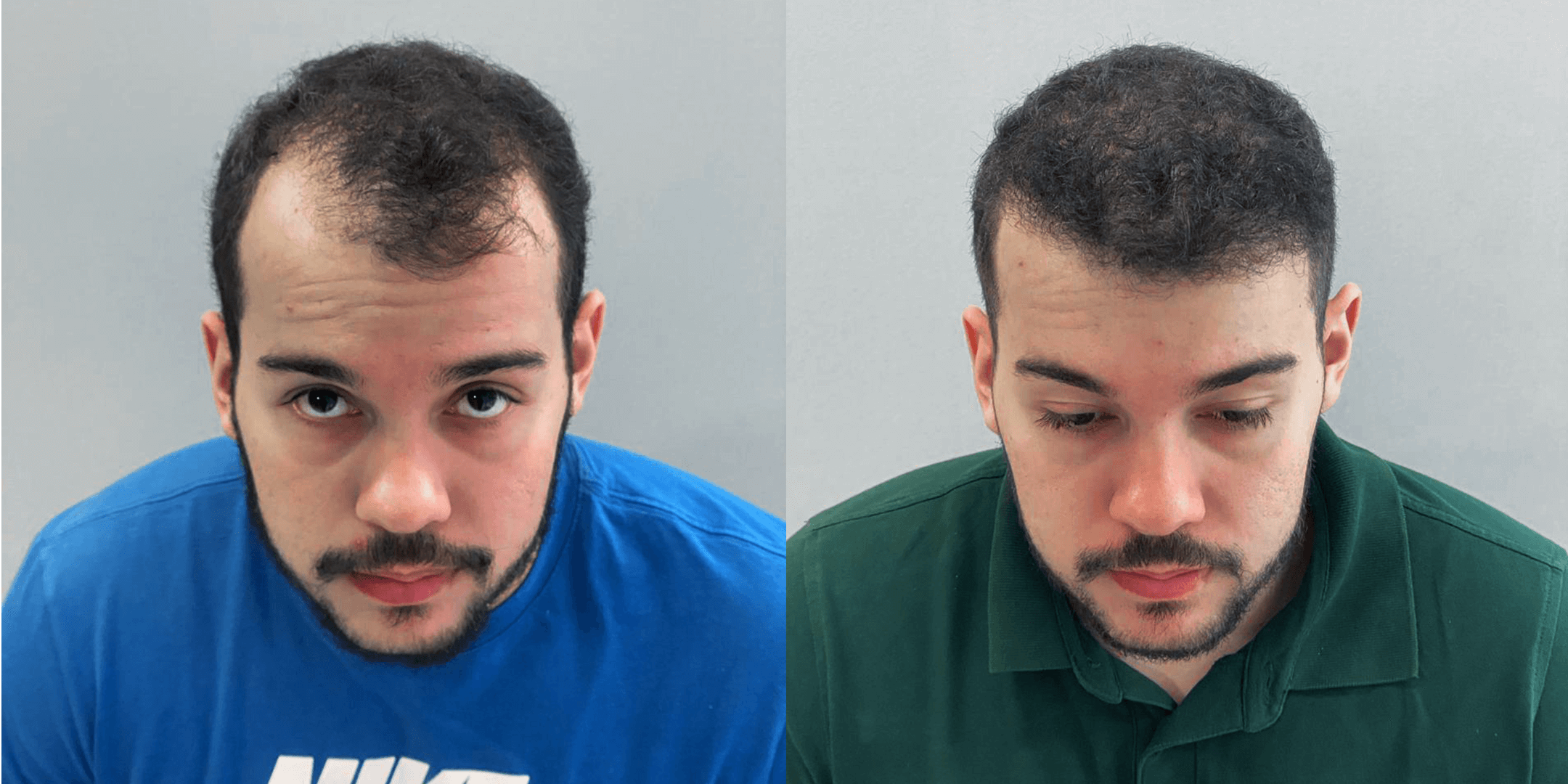 Quarta imagem de Antes e depois de um homem que fez um implante capilar com a Clinica Robotica Capilar