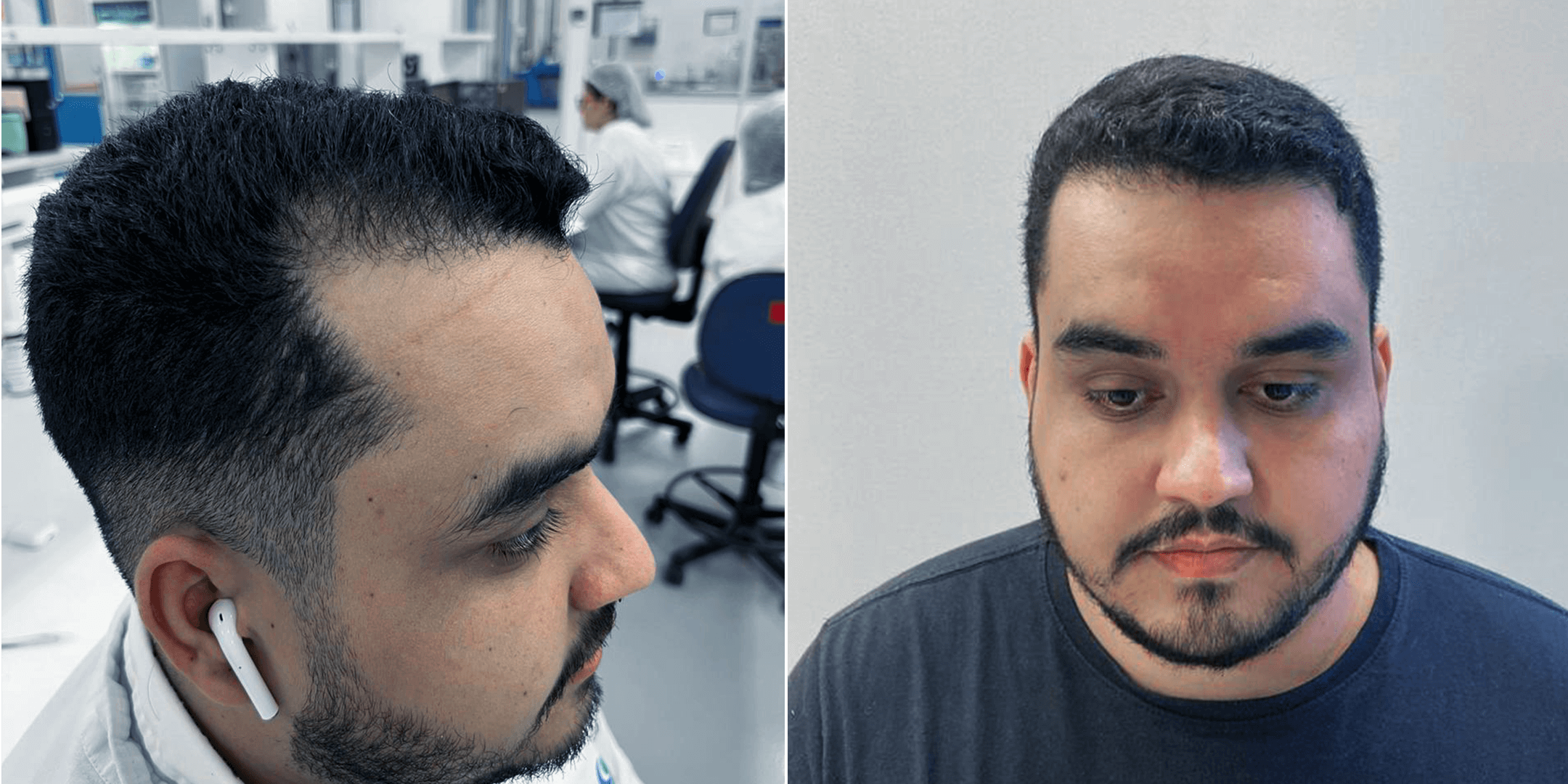 Quinta imagem de Antes e depois de um homem que fez um implante capilar com a Clinica Robotica Capilar