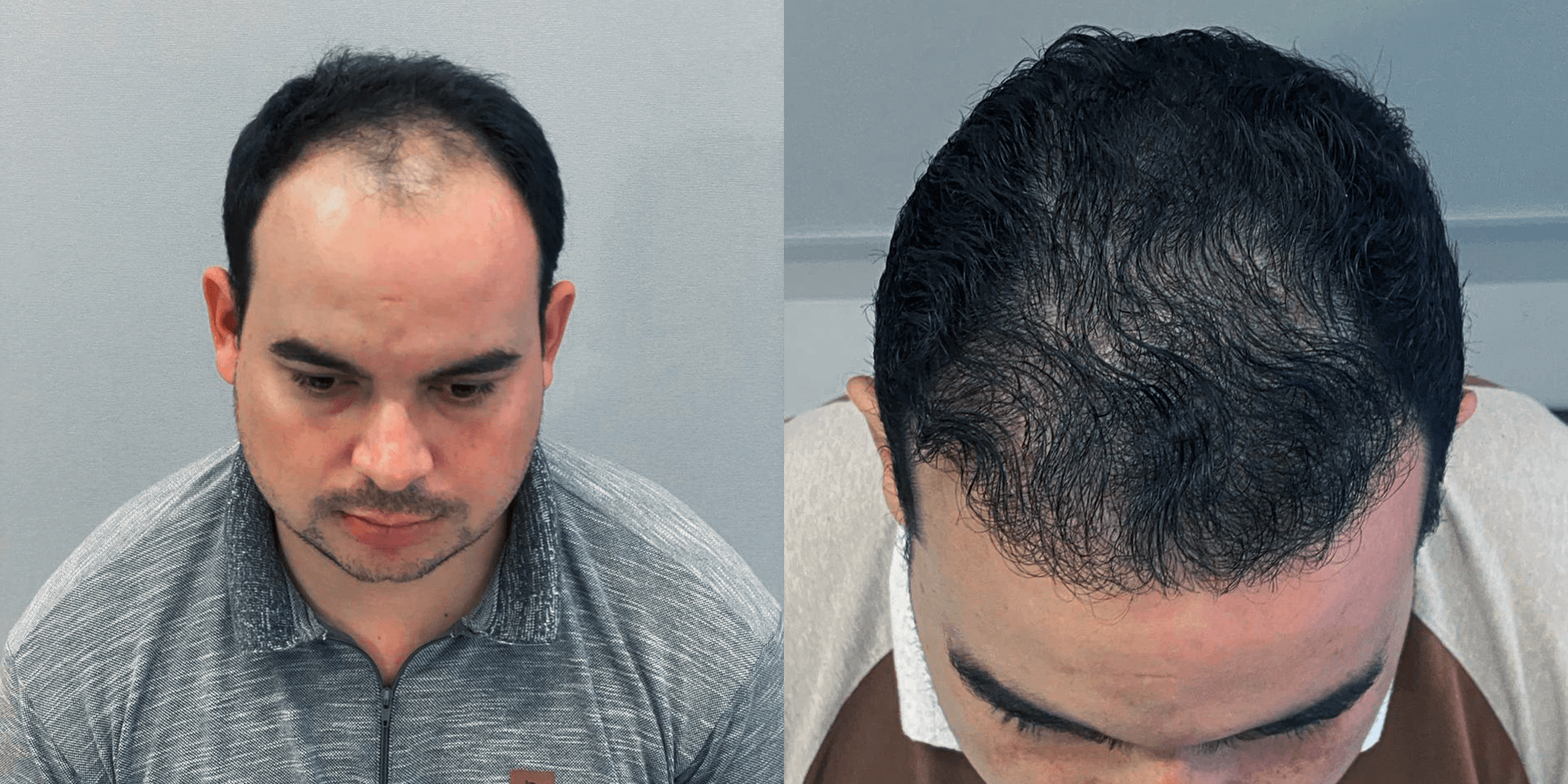 Sexta imagem de Antes e depois de um homem que fez um implante capilar com a Clinica Robotica Capilar